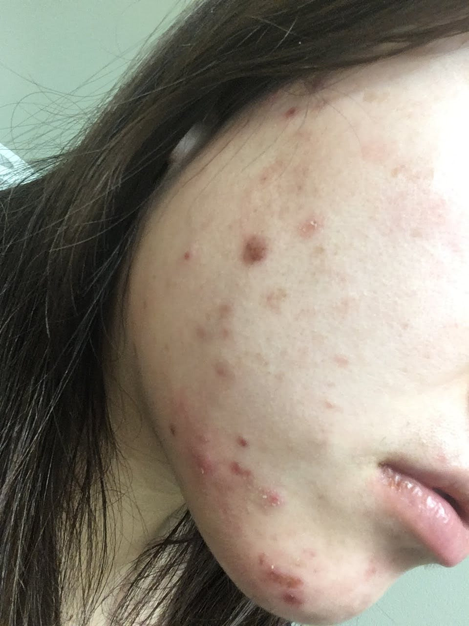 marie curated facial bar acne