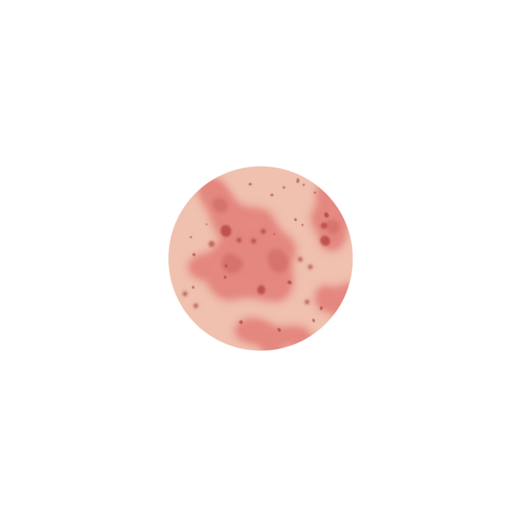 Rosacea